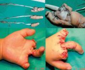 A 3-year-old girl caught her left hand in an escalator when she fell and had an avulsion of all her fingers. Only the middle pinked up after replantation. from 3 dogs fuck girl
