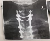 Found the xray from my husband&#39;s bone poking out, posted yesterday. from hd xxxxx indin bf shotactress bhuvaneswari xray