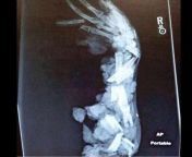 [50/50] [SFW] An x-ray of a normal arm&#124; [NSFW] An x-ray of a messed up arm from tv pepsi uma x ray