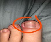 There is red puss on my toe and idk what it is (check body text) from is juniors puss