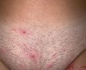 NSFW hi Im a 22 yr old concerned. Noticed after shaving (not sure if that helps) last weeks and have had these very itchy bumps ever since. Havent had sex in 2 months and used condom. Scared this is std. Havent gone to doctor. All on outer region and t from 6th std