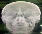 X-ray of a Ukrainian soldier showing a bullet that entered from left cheek and stuck in skull. from tamil actress bhuvaneshwari nude x ray imageski alnmxxx hindi rape v
