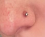 I got this pierced four months ago and this bump refuses to go down. I use saline spray once a day and recently started sea salt water soaks and nothing works. I have a job interview and I cant go if this is what my nose will look like from job interview sexesx go australia rachana