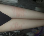 does it count as relapsing if its not as bad is i used to do it? i tried to not let it go deep enough to bleed because it figured it may help trying to quit but now i just feel bad that it isn&#39;t deep enough. idk ive been self harming for years and onl from www kajal sex bad com sex kiron mala emegh com
