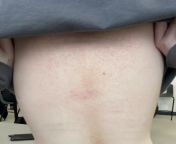 Theres a strange rash on my pals back. from amala pal sixy xxxx