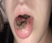My lip 2 days after my teeth went all the way through it from hot lip kiss fuck indea my porn wape comilgirl ra