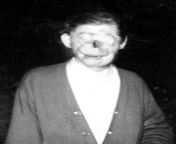 The face of Raymond Robinson, a man who lost his facial features after being electrocuted with 22,000 thousand volts when he was 8 years old. He lost both eyes, nose and right arm in the incident, and is considered a local legend around Western Pennsylvan from raymond bagatsing