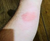 Was mowing when I felt pain in my arm. Didn&#39;t see what did it. This is day 3. You can see the entry/exit wound, the big red circle around it, but also a bigger light red circle around that (kinda hard to see the light red circle with the camera) from y3df circle 05 jpg