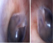What is inside my ears? Photo is inside of my ears, left and right respectively I have been feeling off-balance lately and my right ear feels clogged when i wake up. I&#39;ve been putting off going to a doctor is this dangerous? should i seek medical help from ejaculate medical