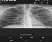 xray - does anyone see anything off ? thanks ! from à§¨à§¦à§§à§« à¦¨à¦¾à¦¯à¦¼à¦•à¦¾ à¦®à§Œà¦¸à§ à¦®à§€à¦° à¦šà§ à¦¦à¦¾à¦° à¦›à¦¬à¦¿ï¿½à¦¾à¦œà¦² à¦“ à¦¸à¦¾à¦²à¦®à¦¾à¦¨ à¦–à¦¾à¦¨à§‡à¦xray aunty nude gangamalayalam filim ac
