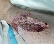 As per my last post here is a follow up to the injury my mum had to her leg. This is the skin graft about 10 days after the injury. I have one more updated pic if people are interested. from play4eal injury