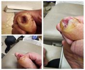 Diabetic tor lesion progress from tropical cuties onion tor gloria