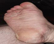 Really rough and peeling skin on foot. Mostly the heel and large toe on the edges. Both feet are like this, any suggestions for treatments? from indian foot filt flips heel sandal