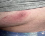 Cellulitis with an abscess (already treated by doctor) illegal pop but wanna pop so bad (my back on left side) from bulbul pop