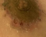 sorry 4 gross pic but uhhh do i have an infection? a couple days ago my right nipple started bleeding a little then scabs formed. they came off today and im worried that this is an infection. i cant see my surgeon at the moment bc im back home and they from college babe visits her bfs home and they fuck in multiple positions