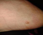 Small lump on ankle from lump com