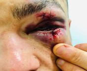 Is Eddie Alvarez&#39;s eye injury that he sustained in his ONE FC debut the worst in MMA? from indan school gril rafe mma