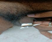 iam from India, age 22 was circumcisised at 13 due to phimosis made this home made retainer , devices not available in my country from ኢትዮጵያ ሴክስ home made