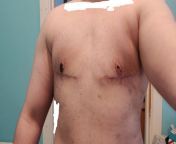 3 Weeks post DI w/free nipple graft. Dr Lago, Madrid. from tamil aunty mali nipple milk dr