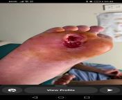 Large hole in foot caused by the removal of a callus from hot saree removal of tamil actor