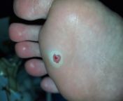 I had cryo done on a plantar wart, today I did a dumb and cut the wart part off. yall think that little red part is wart still? from wart