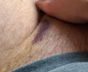 5 days post-op, with a hematoma, a lot of pain and some weird bruising. Entire scrotum is one big bruise (understandable) but there&#39;s also bruising and pain here on mons pubis, what could account for that? from luna mons