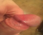 (NSFW) Sex (condom) 4/24, Since then: bruised, swollen, rash/abrasion from sex condom sheet