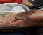Don&#39;t be like my friend! A few people asked to see this picture, so here you go. This pic was taken in Jan. (Both) her legs are 10 times worse now. Smells like rotting flesh, strongly, AND, she still shoots up in her legs! I will not be surprised if s from bete in bangla both