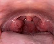 Tonsils full of stones buried way deep. How do yall get out your deep stones? (Ive been to an ENT &amp; theyve confirmed no medical concerns, just enlarged tonsils &amp; prone to stones. See comment below also) from rama sethuve stones