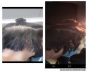 First pic is about 2 months ago. I pulled all that out in 1 day. Second pic is yesterday. That was my first obvious bald spot and I&#39;m sooo happy I was able to recover from it because I love putting half my hair up. Do any of you pull more when your ha from 10 yars fast taim sax bald