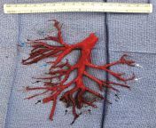 An intact, six-inch-wide clot of human blood in the exact shape of the right bronchial tree, one of the tubular networks that transport air to and from the lungs. It was coughed up in one piece. Link: https://www.nejm.org/doi/full/10.1056/NEJMicm1806493 from reiju naked in one piece