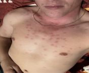 Does this look like a meth rash? from janakapur meth