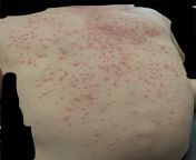 My brother got this rash. He says it’s from his workplace (a lot of dirty air) but he his skin is very prone to acne in general. Does it look like ‘dirt’ rash? from 박보영 deepfake rash