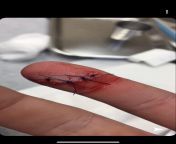 [50/50] Stitched finger after being caught in a meat grinder (NSFW) &#124; A beautiful rose covered in gold (SFW) from wermail in gold