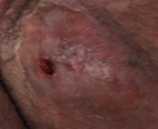 Possibly my final update. Unfortunately I never got to film it and all thats left is a bloody hole. Now Im just looking for ways to make sure it doesnt get infected while healing from film hatim tai all heroine