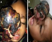 Horrifying medical neglect in a toddler. Her parents took her to the hospital and had her diagnosed with retinoblastoma, an eye cancer, but did not comply with treatment recommendations. Five months later they brought her back in the condition shown. Shefrom married may milli sexy girl took her to the toilet and licked her pussy sister in law whore wee went out mp4