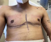 One week post op with Dr.Esther Kim in SF. Feel free to ask any questions you might have from esther alakysi sans tabou kinshasa 18