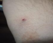 Raised red bump after drawing, not getting blood, and pulling out. blood blister? just relapsed, shot up plenty of times before and this is a first. from sineri heroin times com
