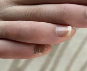 Nail looks funnyfeels a bit brittlesports injury? from bit tow