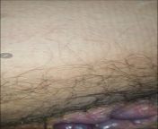 Could this be an internal hemorrhoid? Apologies for the gross photo from fogbank rosiexxx photo pan medical