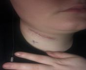 Neck lymph node removal: how long will I have pain swallowing? from 20190 node mujry