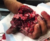 [50/50]Macro shot of Raspberry pie(SFW)&#124; An injured hand(NSFW) from alamat tp an da 140 213 149 50