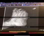 Not terrible but heres the x-ray of my broken foot (x-ray was done on a weird angle so the dislocated knuckle is facing the sole of my foot) from actress seetha x ray nude
