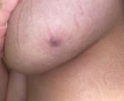 Going to urgent care today but please let me know your thoughts! Does this painful purple lump look like an ingrown hair/cyst or does it look cancerous/something serious? Ive never had this before (its under my left breast). from lump com
