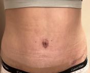 Belly Button Question/Review: is this normal healing? How does this belly button look? I had a small infection on my left side where the drains were but am wondering if there are any issues with my belly button as well. Im already 5 weeks out so not supe from brazilian belly button wors