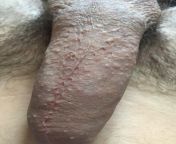 Spots and indents on shaft?! What is this? Ive had small spots on my penis since I was young but over the past 2 years it has gotten very bad... I also have spots on my ball sack too anyone know whats going on? from small teen gay sucks penis