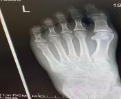 X ray 2nd opinion please? Ive been advised my 5th metatarsal is broken - how serious is the break? from indian 5th school opan