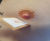 My Torn Nipple after getting a piercing caught in a door from caught in a rut alpha bakugou