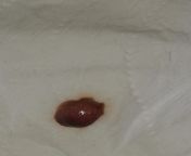 Small pink blob. Female, 28, healthy, non smoker. Had copper coil contraception for 2 years. When wiping after peeing I noticed a small pink blob on the toilet paper, it was not like a blood clot, more tissue like, I am not on my period. Any suggestions? from not on face