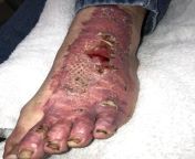 My sons foot, three weeks after deep 2nd degree, partial thickness burns from boiling water. Two weeks after surgery to debride the wounds and skin grafting. One week after second procedure to separate toes. He is 15. from foot fitish flops after xxx